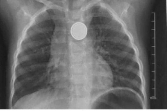 Bé trai bị loét sâu thực quản do nuốt pin cúc áo