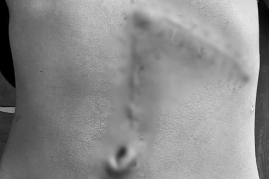 Cứu sống thiếu niên vỡ lách độ 5 sau tai nạn giao thông