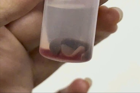 Phát hiện sinh vật lạ sống ký sinh trong hốc mũi người đàn ông