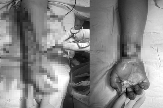 Bị bỏng nặng vì dựng cây nêu chạm đường dây điện