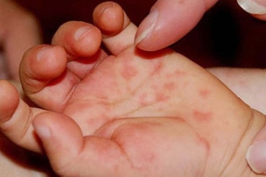 TP.HCM cảnh báo bệnh tay chân miệng trở lại