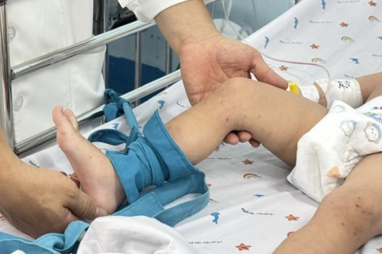 Tay chân miệng gia tăng, Bộ Y tế yêu cầu siết chặt thu dung, điều trị