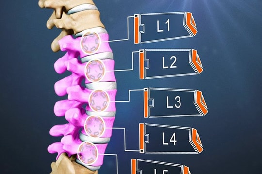 Dấu hiệu nhận biết thoát vị đĩa đệm L2 L3