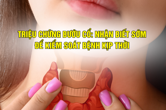 Triệu chứng bướu cổ: Nhận biết sớm để kiểm soát bệnh kịp thời
