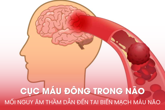 Cục máu đông trong não: Mối nguy âm thầm dẫn đến tai biến mạch máu não