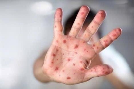 Gia tăng ca bệnh tay chân miệng, Đà Nẵng kích hoạt đồng bộ giải pháp ứng phó