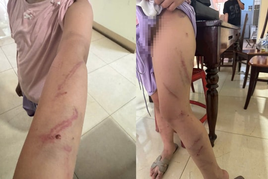 Bé gái 9 tuổi nghi bị bạo hành, cơ thể có 34 vết bầm