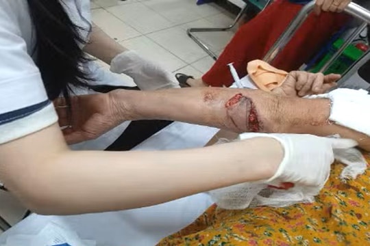 Chó lạ tấn công người đi tập thể dục