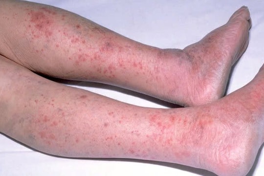 TP.HCM ghi nhận 1 ca tử vong do não mô cầu