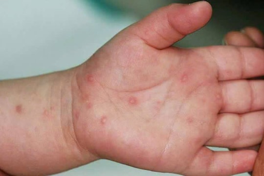 Cà Mau ghi nhận ca tử vong do bệnh tay chân miệng