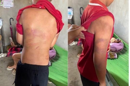 Diễn biến mới vụ cháu bé xuất hiện nhiều vết bầm tím trên cơ thể