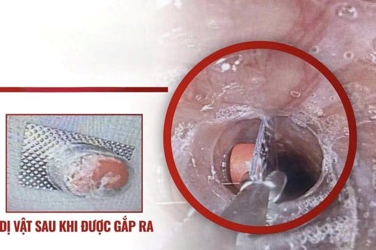 Viên thuốc chưa bóc vỏ mắc trong thực quản bé trai