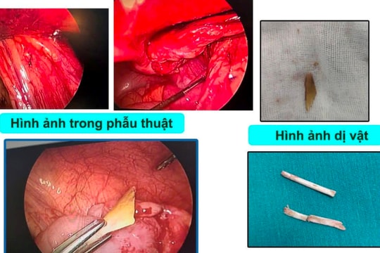 Trẻ 48 tháng tuổi bị xương lợn đâm thủng ruột