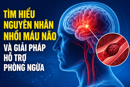 Tìm hiểu nguyên nhân nhồi máu não và giải pháp hỗ trợ phòng ngừa
