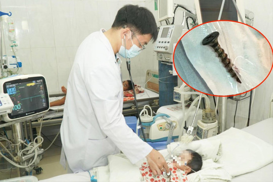 Cứu bé 3 tháng tuổi mắc đinh vít 4cm trong đường thở