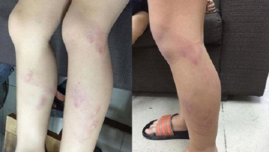 Hà Nội: Tạm đình chỉ cô giáo đánh trẻ lớp 2 tím chân
