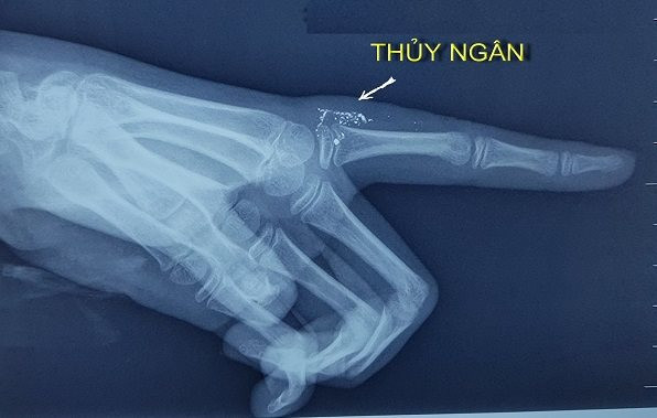 Bé gái 11 tuổi bị nhiễm độc thủy ngân do vỡ nhiệt kế