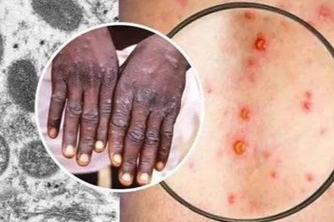 Mỹ: Bang New York ban bố tình trạng khẩn cấp về bệnh đậu mùa khỉ
