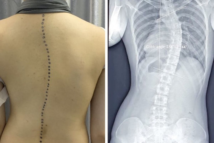 Cột sống cong chữ C, vẹo chữ S ở lứa tuổi học đường