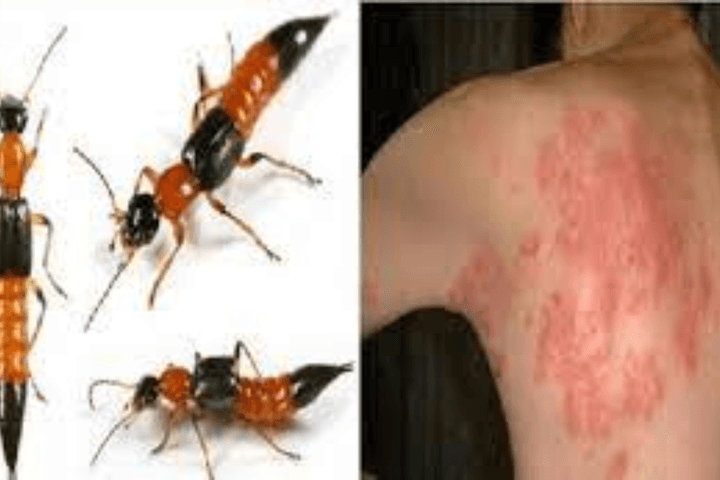 Cách phòng ngừa và xử lý đơn giản, hiệu quả nhất khi bị kiến ba khoang đốt