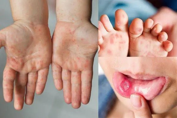 Đồng Nai: Số ca mắc tay chân miệng tăng vọt so với cùng kỳ