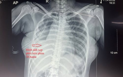 Cứu sống bệnh nhân đứt rời phế quản gốc bên phải nguy kịch