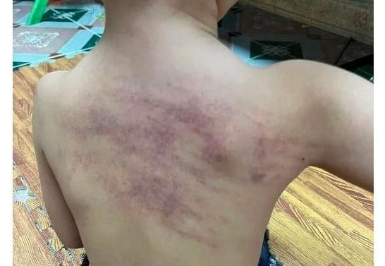 Vụ cháu bé 5 tuổi bầm tím lưng ở Hải Phòng: Yêu cầu có hình thức kỷ luật tập thể, cá nhân liên quan