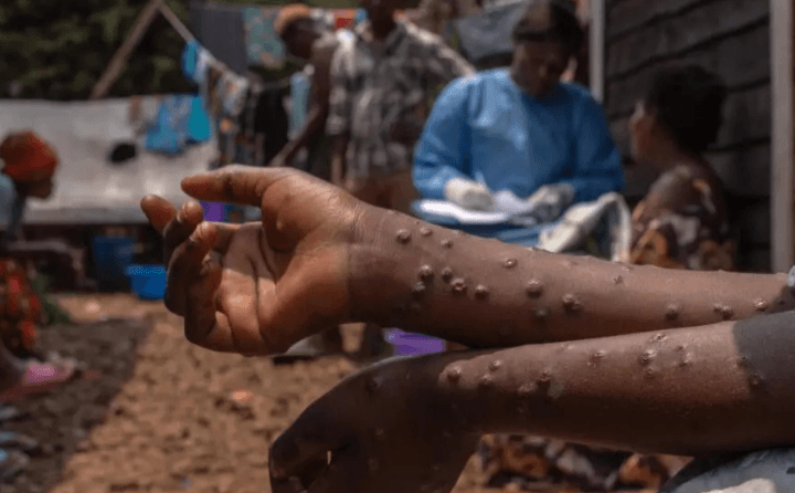 Congo nhận 100.000 liều vaccine mpox đầu tiên