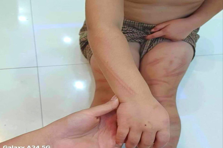 Vụ nhiều trẻ mầm non bị đánh bầm tím: Tạm đình chỉ công tác cô giáo