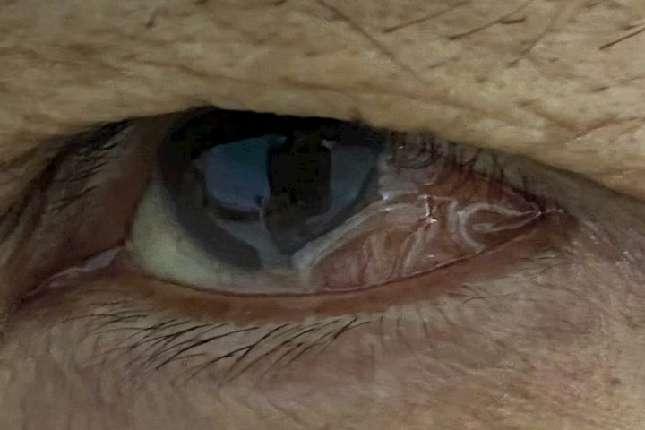 Con giun dài 14cm trong mắt người đàn ông