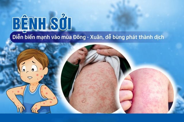 Chưa có thuốc đặc trị bệnh sởi, Bộ Y Tế khuyến cáo phòng bệnh