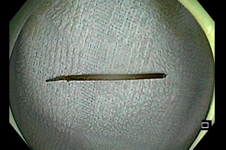 Bị thủng đại tràng vì ngậm tăm khi ngủ