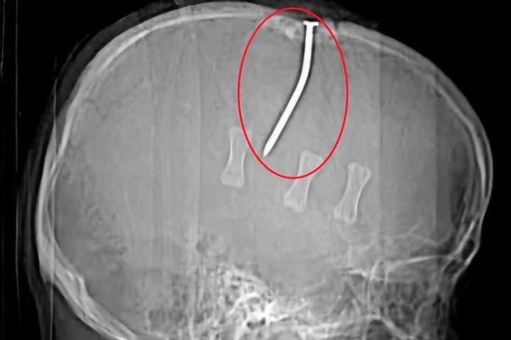 Người đàn ông bị đinh sắt 10cm đóng vào đỉnh đầu