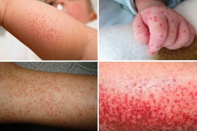 Bộ Y tế: Tăng cường phòng, chống dịch trong giai đoạn giao mùa