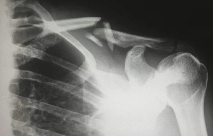 Lạm dụng kem chống nắng, người phụ nữ lăn trên giường cũng gãy xương