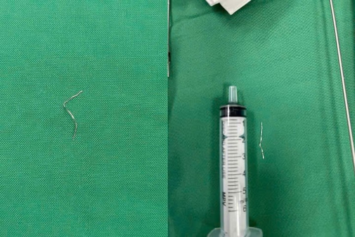 Gắp thành công dị vật kim loại dài 3cm trong lưỡi bé 12 tháng tuổi