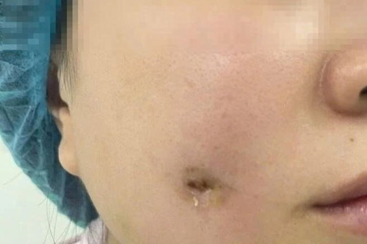 Bị nhiễm trùng sau khi phẫu thuật tạo má lúm đồng tiền