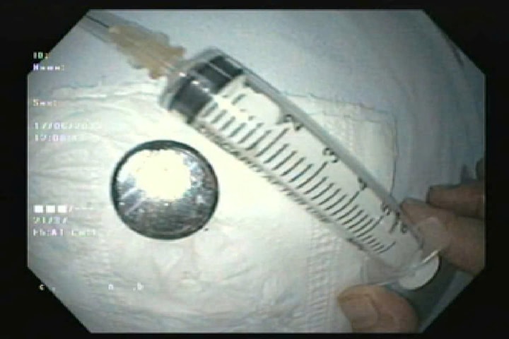 Bé 18 tháng tuổi nuốt pin cúc được cứu sống kịp thời