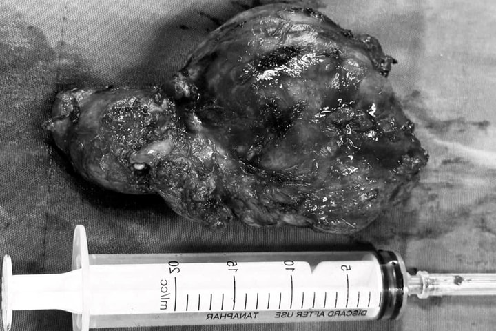 Phẫu thuật thành công khối u tuyến giáp “khủng” cho cụ bà 93 tuổi