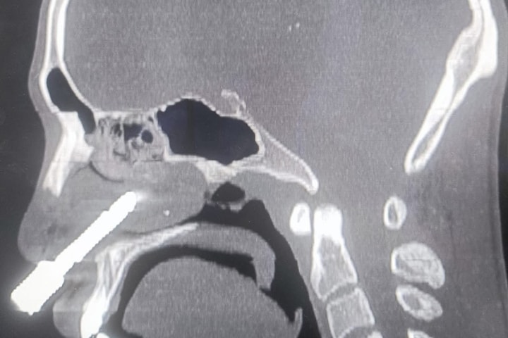 Hy hữu: Nam nhanh niên bị mũi khoan đá đâm xuyên hốc mũi