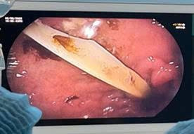 TP.HCM: 2 người phải nhập viện vì hóc xương