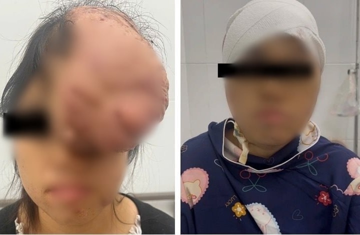 7 giờ loại bỏ khối u sụn xương sọ khổng lồ cho một bệnh nhân nữ