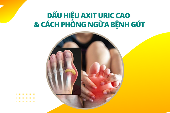 Dấu hiệu axit uric cao và cách phòng ngừa bệnh gút