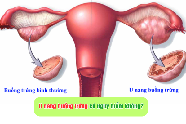U nang buồng trứng có nguy hiểm không?