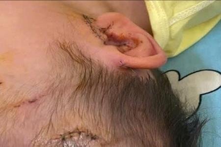 Bé 19 tháng tuổi nhập viện vì bị chó cắn ở vùng đầu và cổ