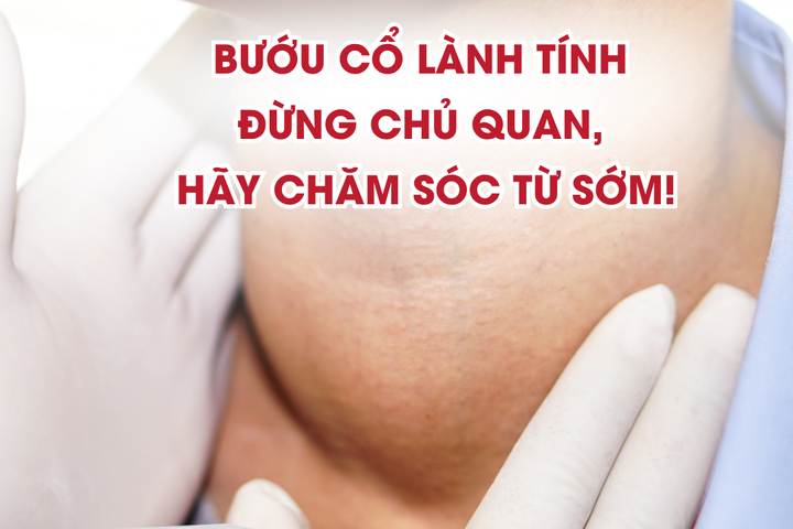 Bướu cổ lành tính phải làm sao? Cách cải thiện và chăm sóc hiệu quả