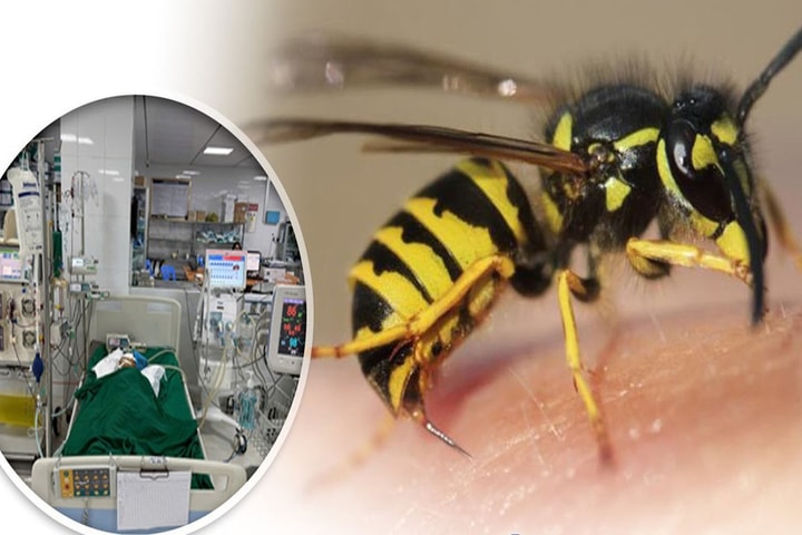 Cứu sống bé gái bị ong vò vẽ đốt hơn 50 nốt