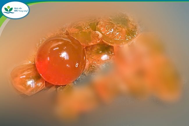 Bé trai 14 tháng tuổi phải mổ cấp cứu vì nuốt hạt nở