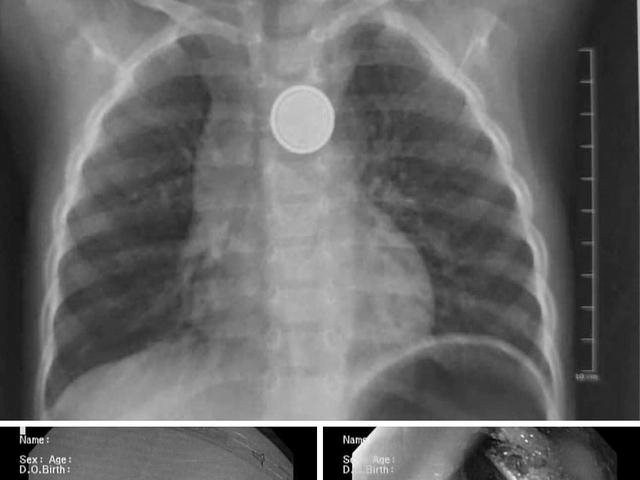 Bé trai bị loét sâu thực quản do nuốt pin cúc áo