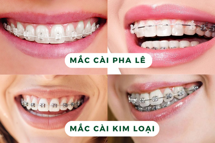 ‏Niềng răng mắc cài pha lê là gì? Ưu nhược điểm của phương pháp này‏